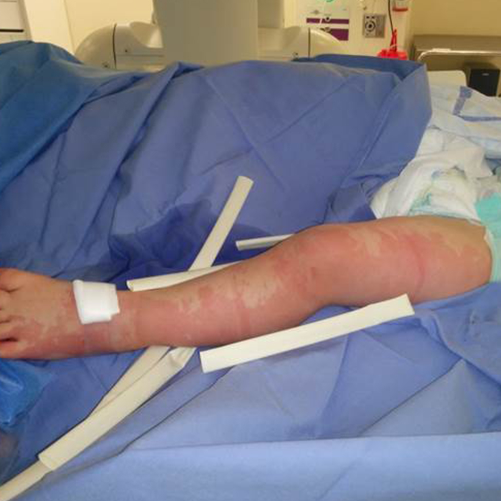 Capillary Malformation 1