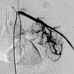 Hemangioma a