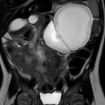 Lymphatic Malformation 3