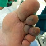 Venous Malformation 1
