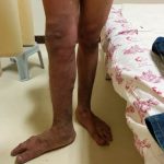 Venous Malformation 3