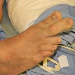 Venous Malformation 3a