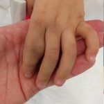 venous malformation 13