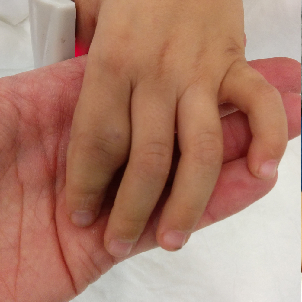 Read more about the article Venous Malformations
