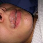 venous malformation 16