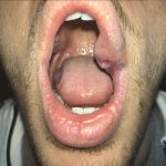 venous malformation 17
