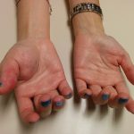 venous malformation 19