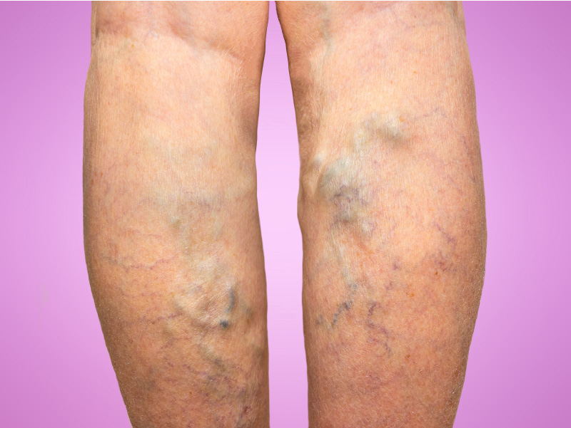Read more about the article Are varicose veins a ‘real’ medical problem, or only cosmetic?
